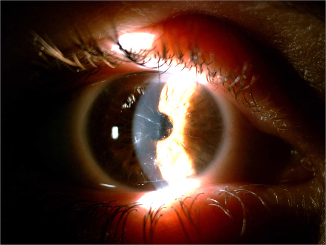 Cyclosporine eye drops in lattice corneal dystrophy type 1: case report.