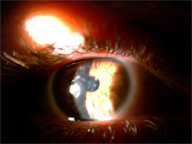 Cyclosporine eye drops in lattice corneal dystrophy type 1: case report.