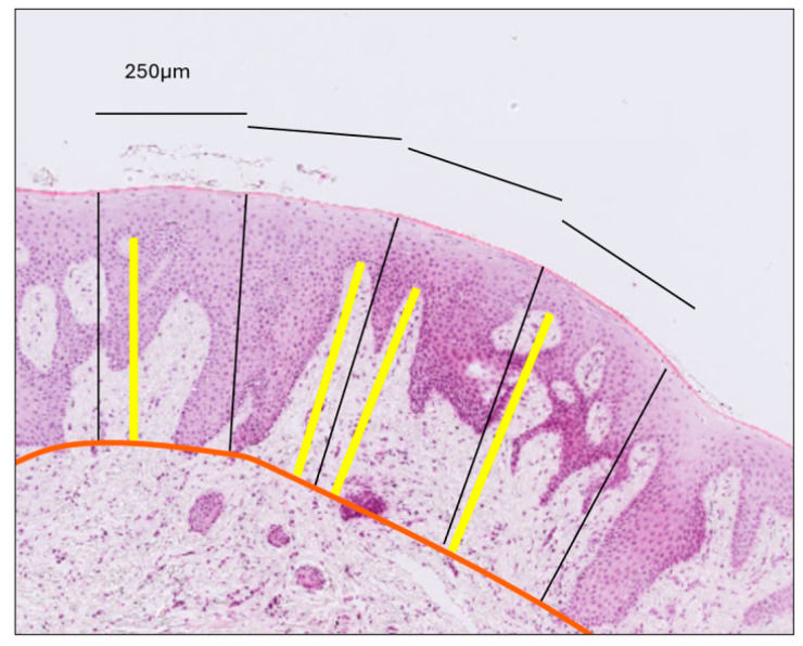 Histomorphometric Evaluation of Gingival Phenotypic Characteristics: A Cross-Sectional Study.