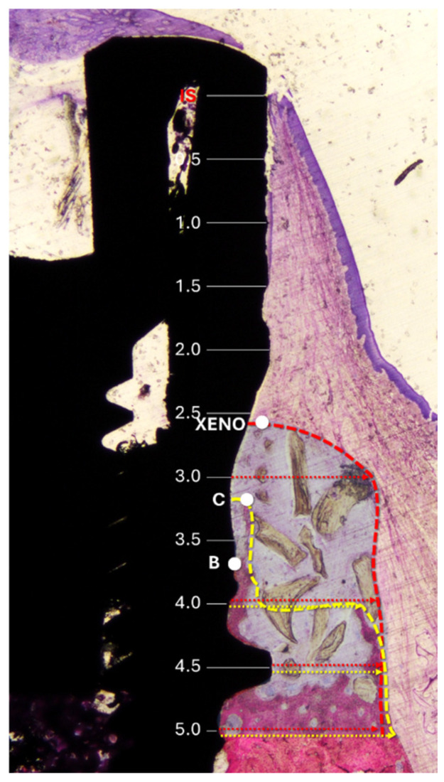 The Effect of Collagen Membrane Fixation with Pins on Buccal Bone Regeneration in Immediate Dental Implant Sites: A Preclinical Study in Dogs.