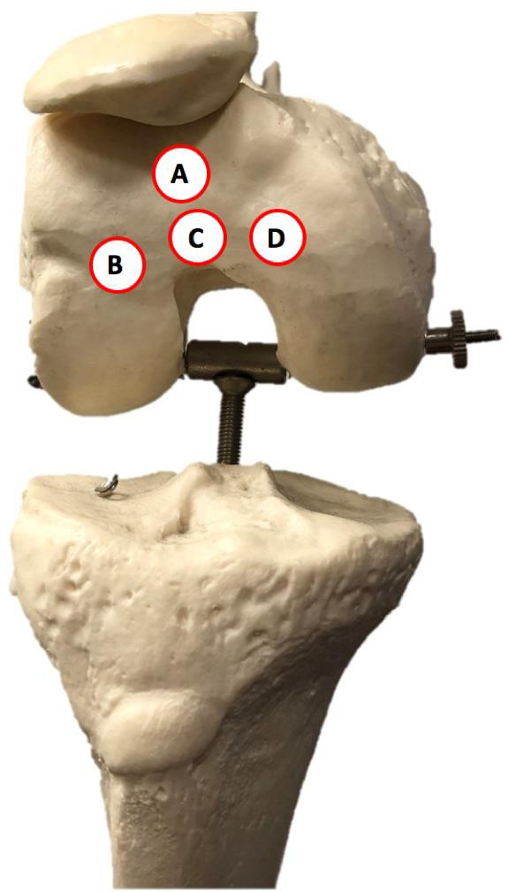Navigation in total knee arthroplasty: a resident's friend or foe?