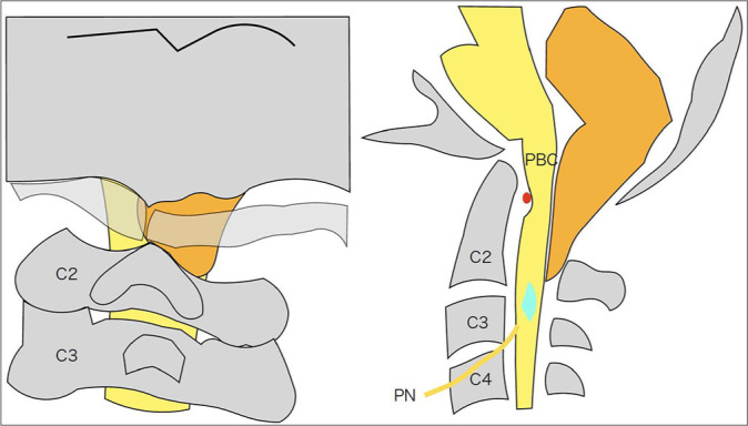 Cough syncope and central sleep apnea caused by CM1 with atlas assimilation in adult: An illustrative case.