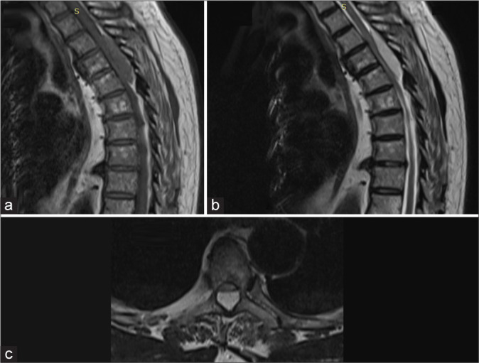 Paraplegia due to epidural T3-T5 hemorrhage of cavernous hemangioma.