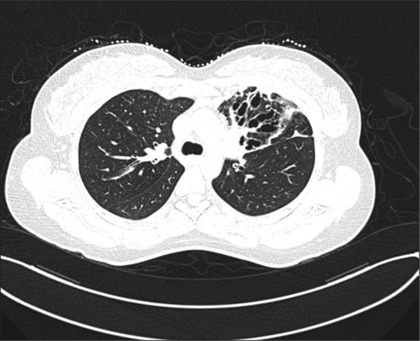 Allergic Bronchopulmonary Aspergillosis Misdiagnosed as Non-resolving Pneumonia: A Case Report.
