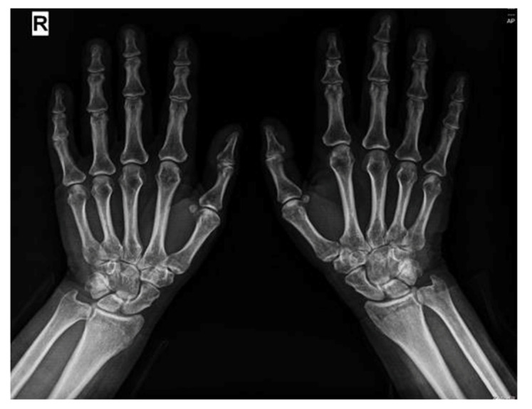 Reclassification of Seronegative Rheumatoid Arthritis as Anti-PL-12 Antisynthetase Syndrome with Interstitial Lung Disease and Joint Involvement-Case Report.