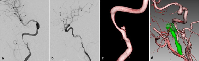 Internal carotid artery dissection presenting with glossopharyngeal nerve dysfunction: A case report.