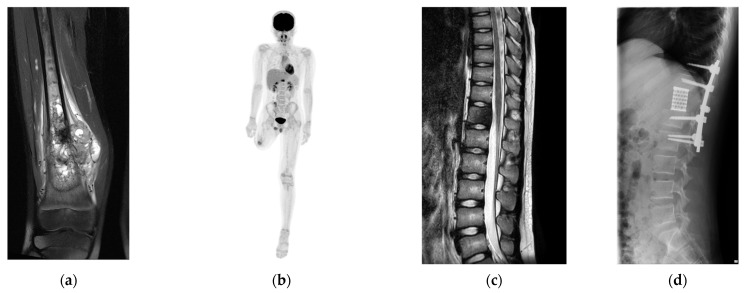 Immunologic Alteration After Total En-Bloc Spondylectomy with Anterior Spinal Column Reconstruction with Frozen Tumor-Containing Bone Autologous Grafts: A Case Report in a Prospective Study.