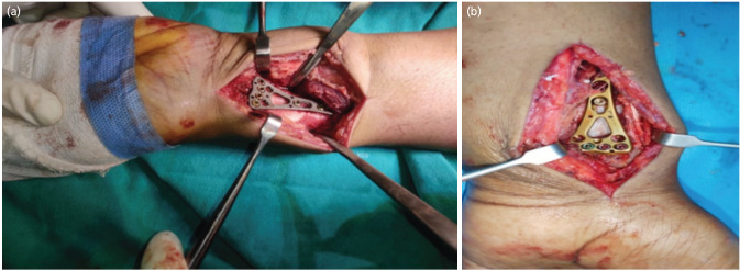 Evaluation of the Functional and Radiological Outcomes of Fixed Angle versus Variable Angle Volar Locking Compression Plates in Managing Intra-articular Fractures of Distal End Radius.