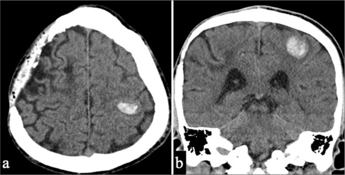 Probable cerebral amyloid angiopathy-related inflammation presenting with dissociated hemorrhagic and inflammatory lesions in a middle-aged patient: A case report.