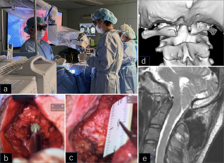 Mini-open exoscopic surgery for C1 restenosis 7 years after decompression of Chiari malformation type 1 with atlas assimilation.
