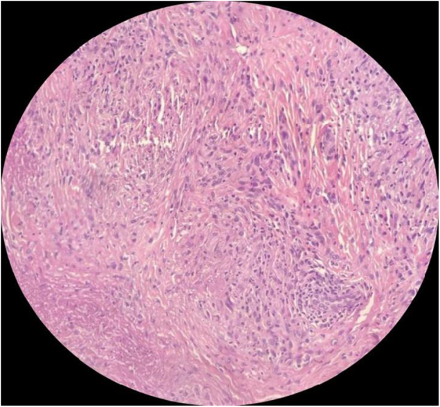 A rare presentation of subcutaneous granuloma annulare: a case report of bilateral palmar and dorsal hand nodules with successful management.