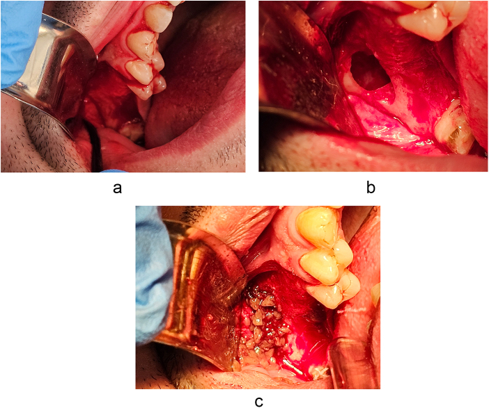 Efficacy of platelet-rich albumin and fibrin gel in two-stage lateral sinus lift: a prospective study.