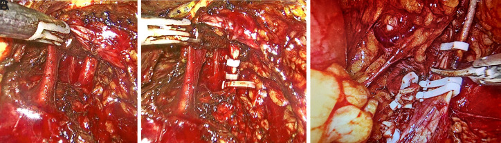 A Novel Hybrid Surgical Technique for Large Renal Masses-Hybrid Technique of Laparoscopic-Assisted Open Radical Nephrectomy.
