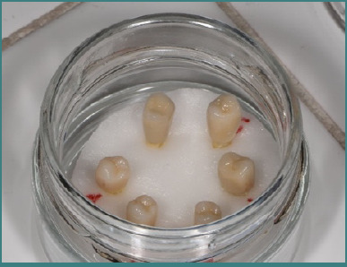 Experimental study on the compressive strength of fixed prosthetic restorations on tooth preparations with or without horizontal preparation.