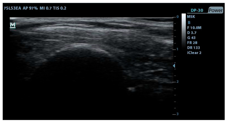 Percutaneous Electrolysis, Percutaneous Peripheral Nerve Stimulation, and Eccentric Exercise for Shoulder Pain and Functionality in Supraspinatus Tendinopathy: A Single-Blind Randomized Clinical Trial.