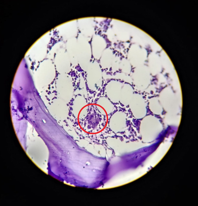 Fever of Unknown Origin in a Renal Transplant Recipient.