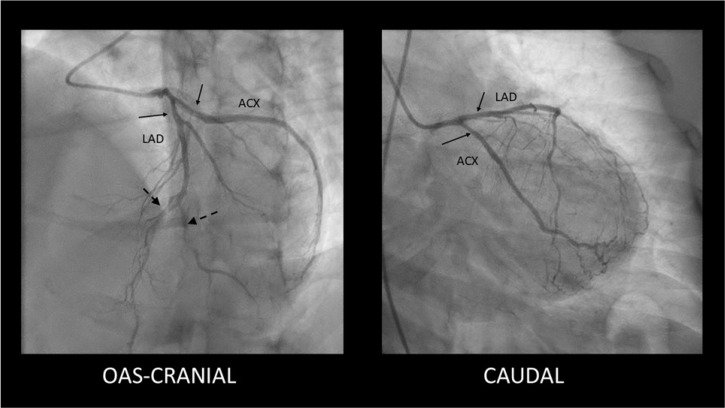 Spontaneous Coronary Artery Dissection Unveiled: Pathophysiology, Imaging, and Evolving Management Strategies.