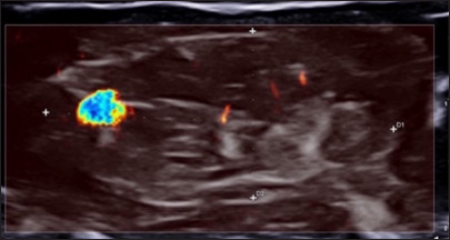 Arteriovenous malformation hemangioma of the ulnar artery: A case report highlighting challenges in diagnosis and surgical management.