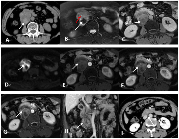 Late retroperitoneal recurrence of adult-type ovarian granulosa cell tumors: Two case reports and literature review.