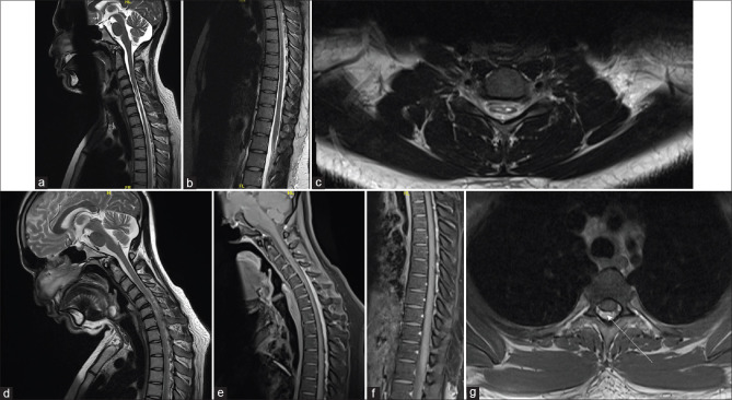 In-Depth Understanding of Hirayama Disease: Dural Detachment Beyond Cervical Spine.