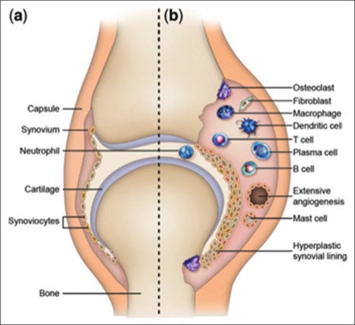 Pathogenesis and Current Treatment Strategies in Rheumatoid Arthritis: A Systematic Review Article.