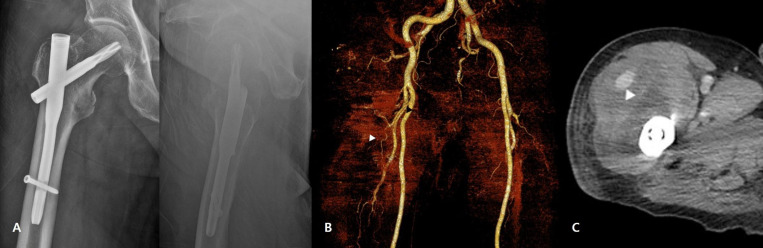 Iatrogenic injury to the descending branch of the lateral circumflex femoral artery during intertrochanteric fracture fixation: a case report of guide pin-related vascular complication.