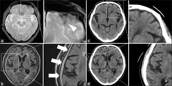 Contrecoup raccoon sign following minor posterior head injury without visible injury: Diagnostic challenge in an asymptomatic older adult man.