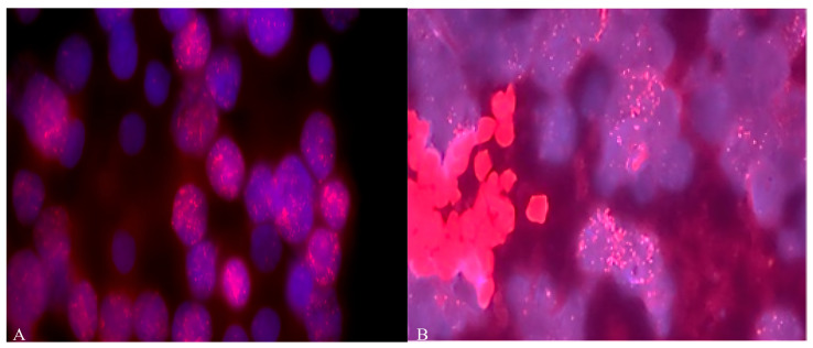 The Prognostic Value of Amplification of the <i>MYCC</i> and <i>MYCN</i> Oncogenes in Russian Patients with Medulloblastoma.