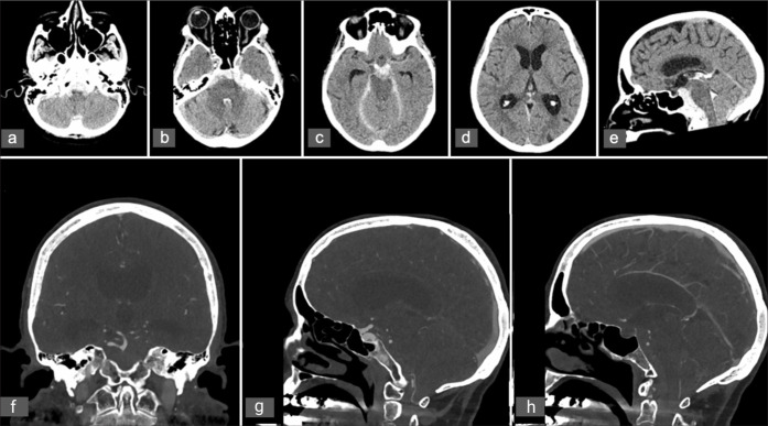 Subarachnoid hemorrhage secondary to Chiari 1 malformation in a patient presenting with recurrent severe headache: A case report, imaging, and anatomic considerations.