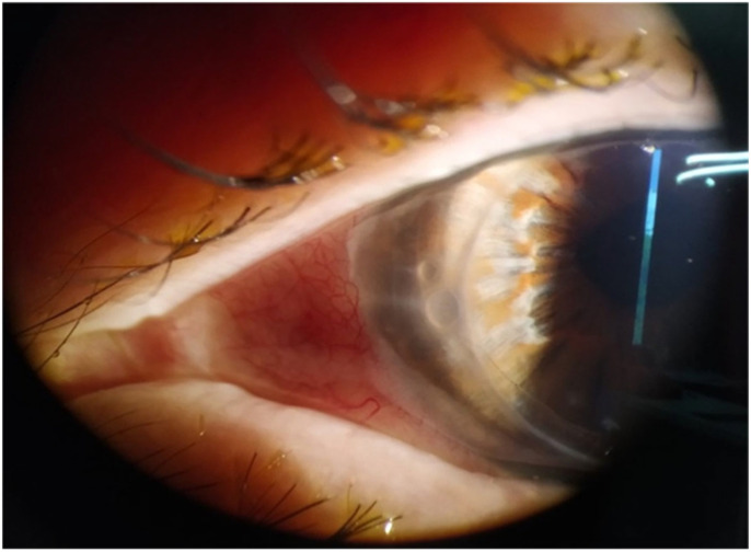 Case Series: Reactivation of Herpetic Keratitis After COVID-19 mRNA Vaccination During Herpetic Prophylaxis.