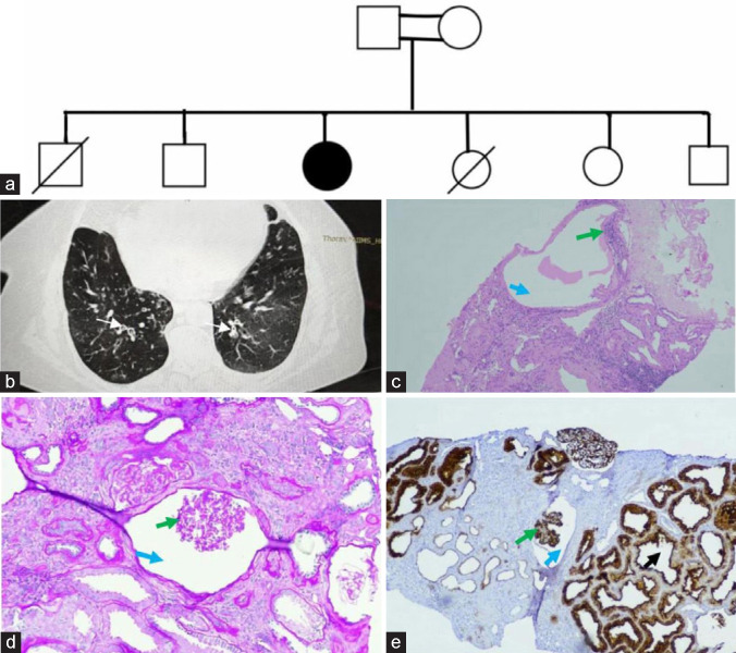 Glomerulocystic Kidney Disease in an Adult with DNAH1 Mutation: A Case Report.