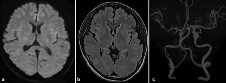 Internal carotid artery dissection presenting with glossopharyngeal nerve dysfunction: A case report.