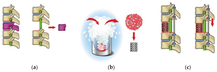 Immunologic Alteration After Total En-Bloc Spondylectomy with Anterior Spinal Column Reconstruction with Frozen Tumor-Containing Bone Autologous Grafts: A Case Report in a Prospective Study.