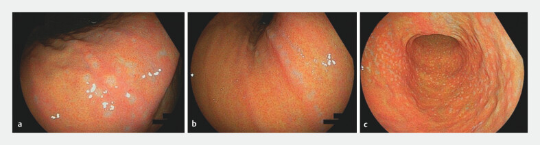 Barnacle-like lesions in the gastric mucosa: Clinicopathological study of a novel endoscopic finding.