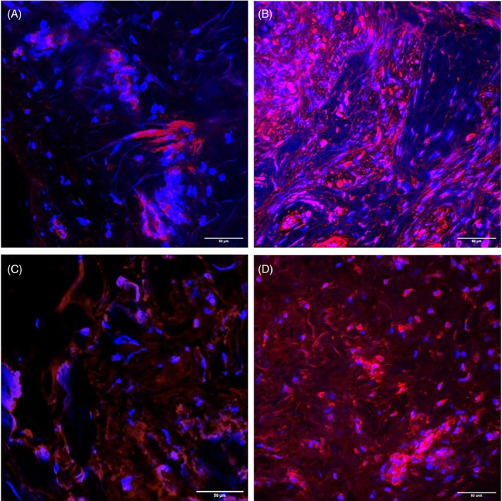 Effects of Oxygen Manipulation on Myofibroblast Phenotypic Transformation in Patients With Radiation-Induced Fibrosis.