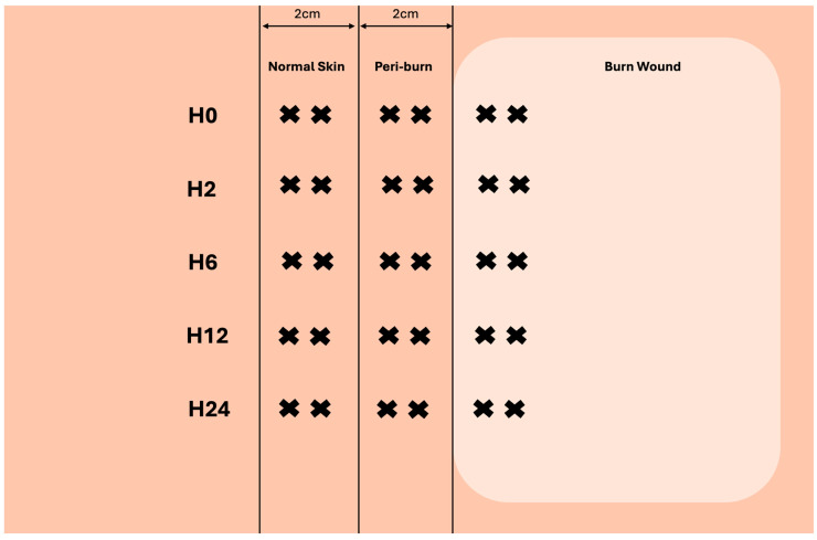 Pilot Study on Resuscitation Volume's Effect on Perfusion and Inflammatory Cytokine Expression in Peri-Burn Skin: Implications for Burn Conversion.