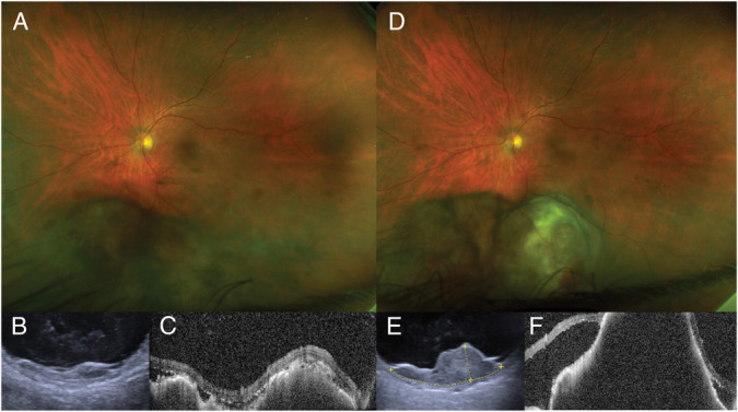 Dissemination of Uveal Melanoma After Diagnostic Biopsy With 23-Gauge Vitrector.