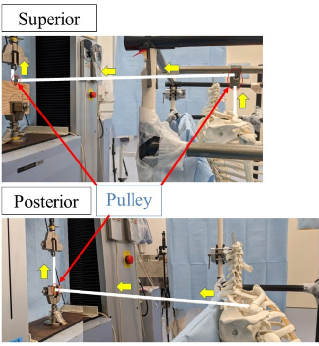 Effects of acromioclavicular and coracoclavicular ligament stability on acromioclavicular joint dislocation: insights from a cadaveric study.