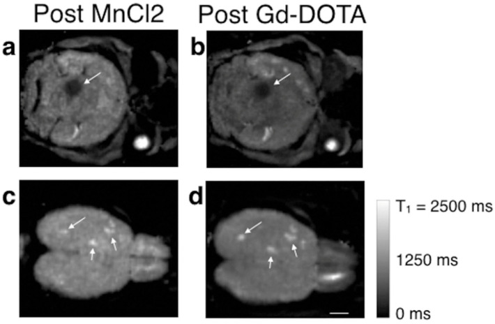 Manganese-Based Contrast Agents as Alternatives to Gadolinium: A Comprehensive Review.