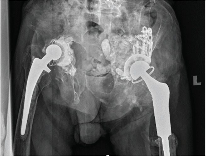 Two-stage Acetabular Impaction Bone Grafting: A Case Report.