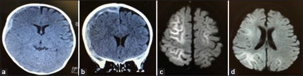 Clinical characteristics of infantile traumatic brain injury with a biphasic clinical course and late reduced diffusion among pediatric patients with traumatic brain injury.