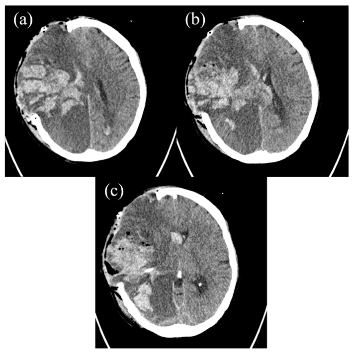 Diagnostic Challenges in Acute Leukemia: From Dental Pain to Catastrophic Intracerebral Hemorrhage.