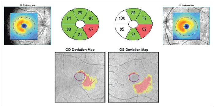 Optical Coherence Tomography of the Macular Ganglion Cell Complex Demonstrating Transsynaptic Retrograde Degeneration from a Temporal Lobe Tumor: A Case Report.
