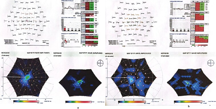 Evaluating the long-term efficacy of umbilical cord-derived mesenchymal stem cell therapy in retinitis pigmentosa: findings from a 1-to-4-year follow-up.