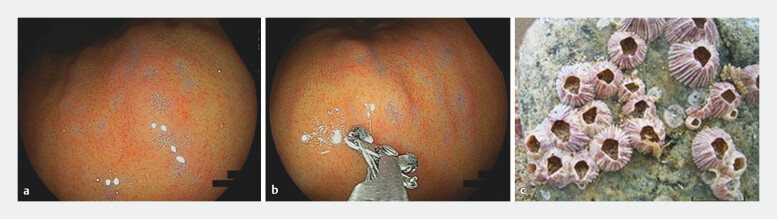 Barnacle-like lesions in the gastric mucosa: Clinicopathological study of a novel endoscopic finding.