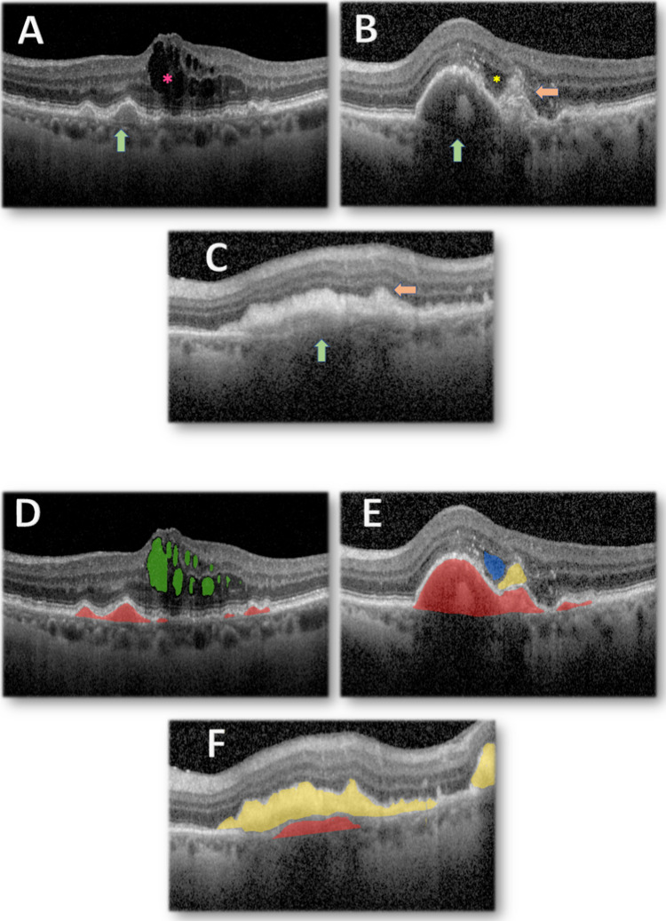 Imaging biomarkers and artificial intelligence for diagnosis, prediction, and therapy of macular fibrosis in age-related macular degeneration: Narrative review and future directions.
