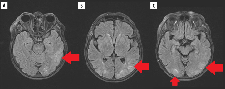 Rare complications of Crohn's disease - a series of three cases.