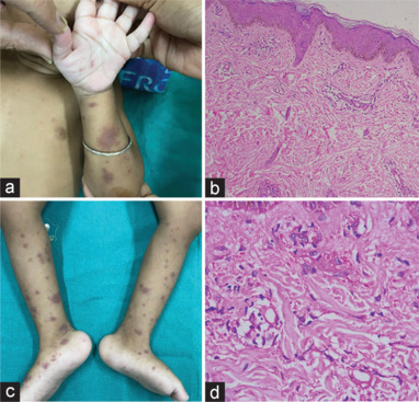 Zonisamide-induced vasculitis: A rare entity.
