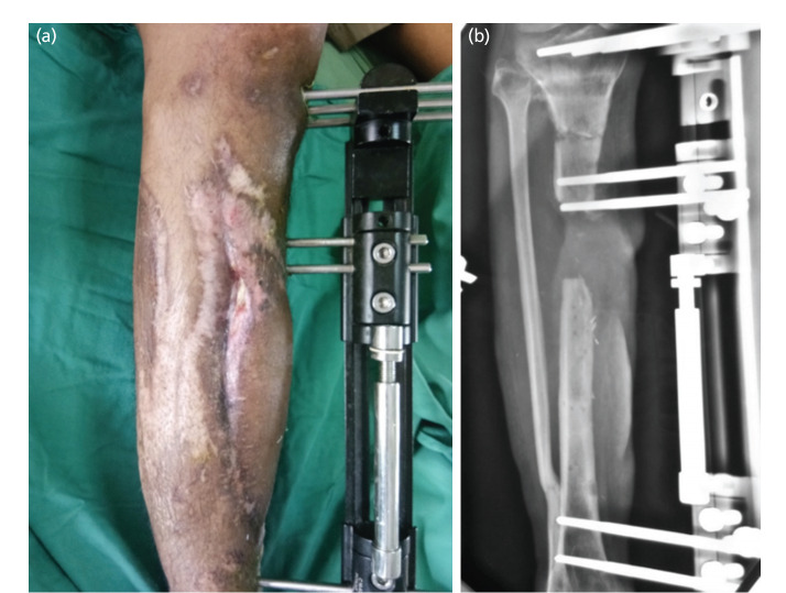 Clinical and Functional Outcomes of Ilizarov Bone Transport in Traumatic Tibial Bone Loss.