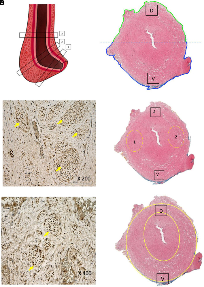 Histotopographic Reasons for Ventral Approach in Bulbous Non-Transecting Urethroplasty.